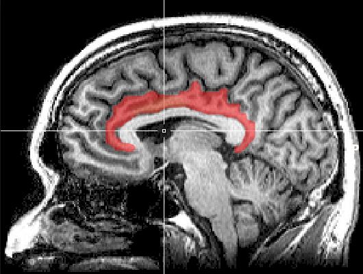      :  Mri cingulate cortex Sutudy Blue